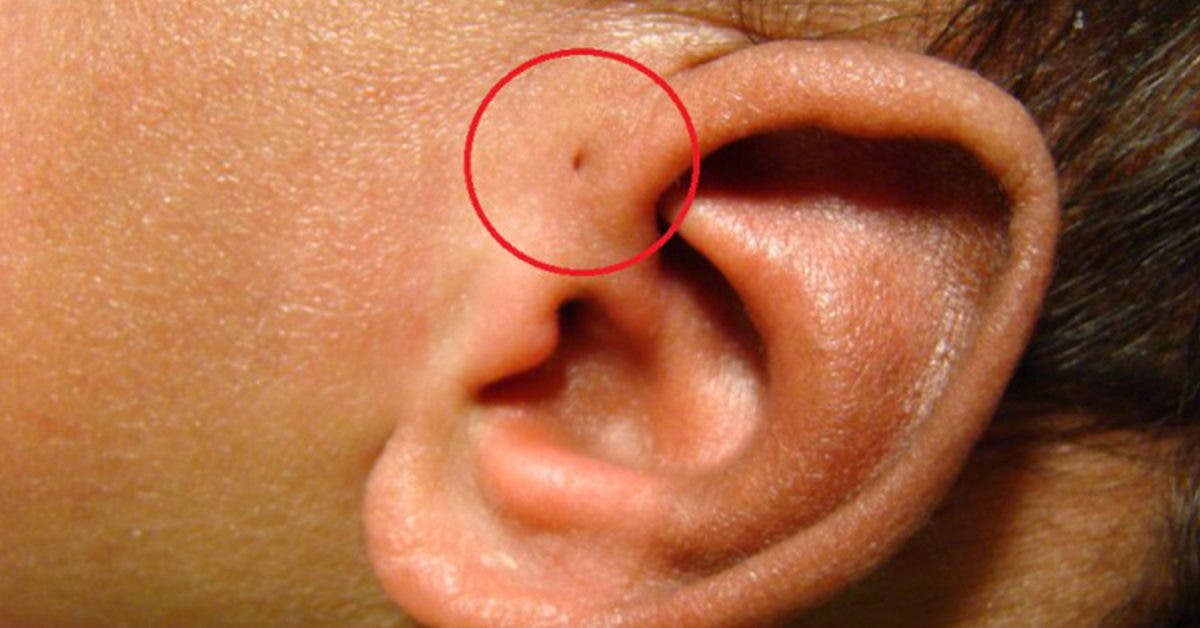 Pourquoi certaines personnes ont des petits trous près des oreilles